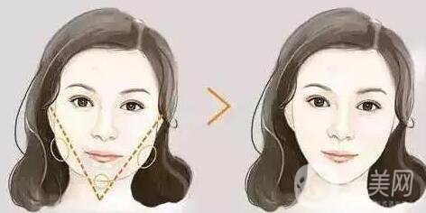 去頰脂墊價(jià)格貴不貴?收費(fèi)情況說明