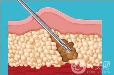 聚能吸脂的優(yōu)缺點盤點