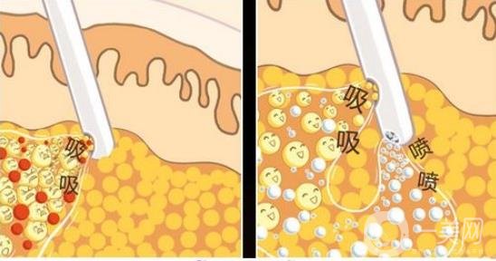 聚能吸脂的優(yōu)缺點盤點