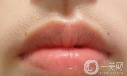 臉部脫毛手術(shù)大概需要多少錢？