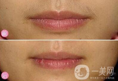 臉部脫毛手術(shù)大概需要多少錢？