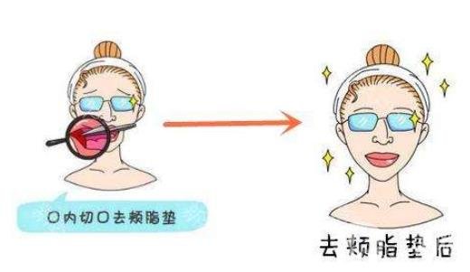 去頰脂墊*果怎么樣？*嗎？