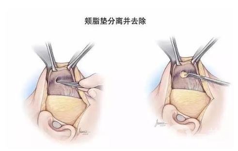 去頰脂墊*果怎么樣？*嗎？