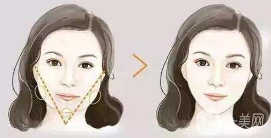 去頰脂墊*果怎么樣？*嗎？