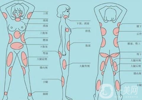 全身抽脂減肥多少錢？貴嗎？