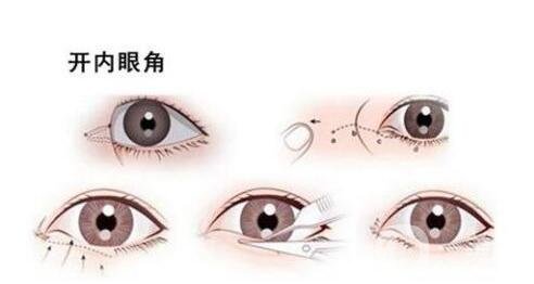 開眼角手術過程中疼嗎?要多久?