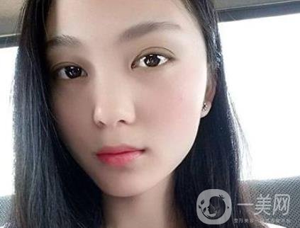 吸雕雙眼皮手術(shù)是什么？是埋線嗎？