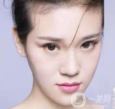 像素激光去痘的*果好嗎？會反彈嗎？