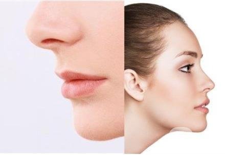 怎樣讓鼻子變高？隆鼻可以讓鼻子變高嗎？