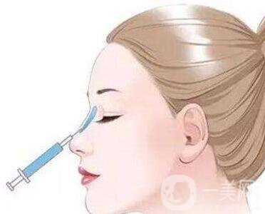 瑞蘭玻尿酸注射除皺*果怎么樣？