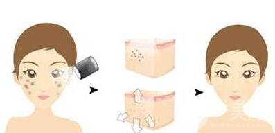 光子嫩膚的原理是什么？*果怎樣？