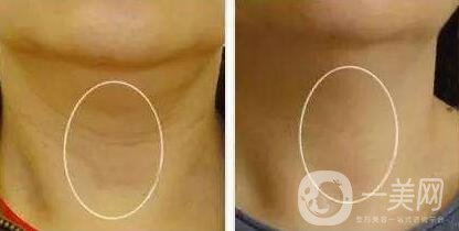 頸部除皺提升術(shù)要多少錢？貴不貴？