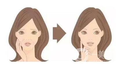 頸部除皺提升術(shù)要多少錢？貴不貴？