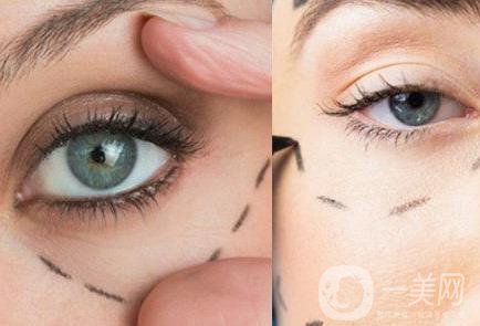 臥蠶和眼袋的區(qū)別解說