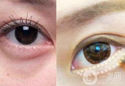 臥蠶和眼袋的區(qū)別解說