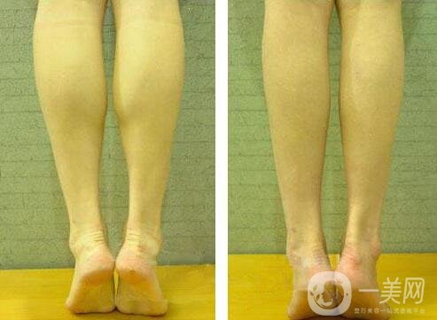 小腿吸脂有什么危害?會反彈嗎?