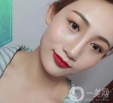 長沙微恩醫(yī)療整形醫(yī)院 隆鼻