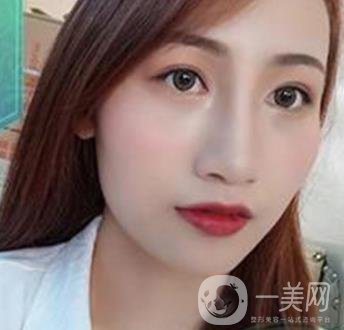 長沙微恩醫(yī)療整形醫(yī)院 隆鼻