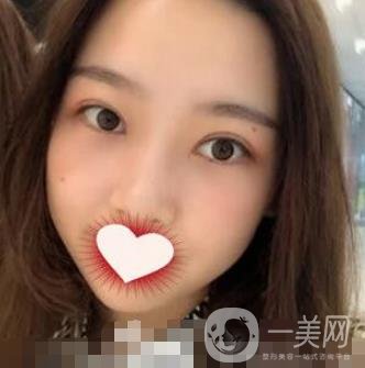 西南醫(yī)院整形美容外科雙眼皮