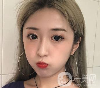 西安葉子整形美容醫(yī)院雙眼皮