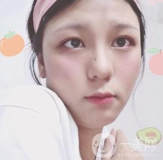 六盤水友好整形醫(yī)院雙眼皮