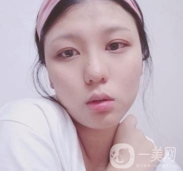 六盤水友好整形醫(yī)院雙眼皮