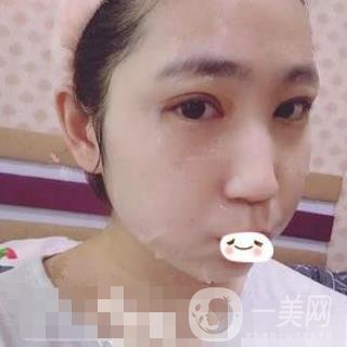 濟(jì)南旭美整形醫(yī)院靠譜嗎?附雙眼皮案例和全新價(jià)格表