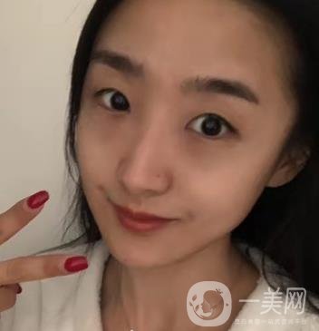 吉大一院整形外科價(jià)格表明細(xì)公布，隆鼻紀(jì)實(shí)案例分享