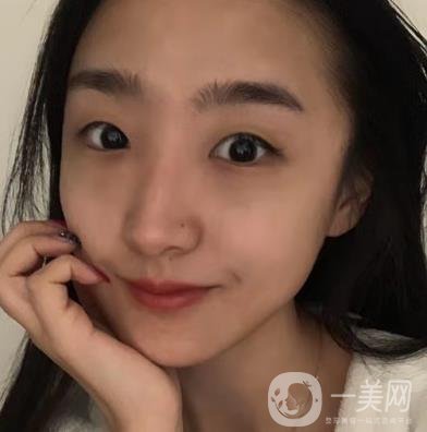 吉大一院整形外科價(jià)格表明細(xì)公布，隆鼻紀(jì)實(shí)案例分享