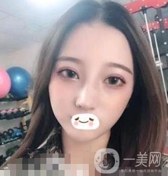 廣州禾麗醫(yī)院做雙眼皮怎么樣?看*果圖和價(jià)格表
