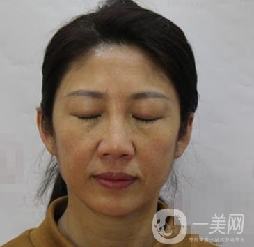 安徽醫(yī)科大學(xué)第(一)附屬醫(yī)院整形外科價(jià)格表，附去眼袋案例