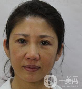 安徽醫(yī)科大學(xué)第(一)附屬醫(yī)院整形外科價(jià)格表，附去眼袋案例