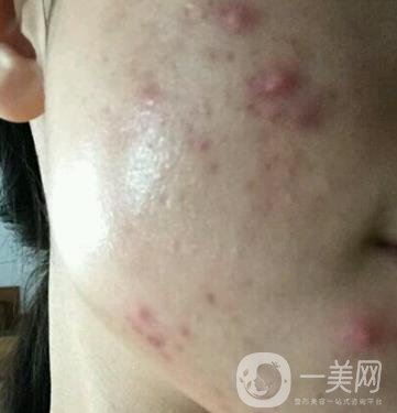 江門夢想整形醫(yī)院去痘印需要多少錢?價格表和真人整形日記一覽