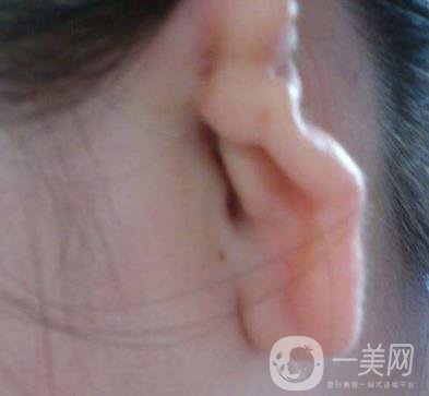 2020年石家莊第(一)醫(yī)院整形美容科價格表和耳朵畸形修復案例一覽