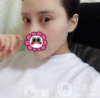 溫嶺芘麗芙整形醫(yī)院2020年價格表更新_雙眼皮整形*果實拍