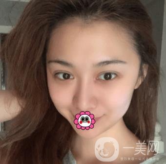 延吉金光善整形美容醫(yī)院價(jià)格表收費(fèi)明細(xì)_雙眼皮手術(shù)真人體驗(yàn)分享