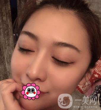 延吉金光善整形美容醫(yī)院價(jià)格表收費(fèi)明細(xì)_雙眼皮手術(shù)真人體驗(yàn)分享