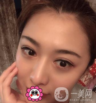 延吉金光善整形美容醫(yī)院價(jià)格表收費(fèi)明細(xì)_雙眼皮手術(shù)真人體驗(yàn)分享