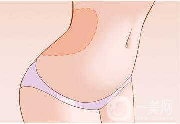 腰腹吸脂是局麻還是全麻?手術(shù)過程中會痛嗎?