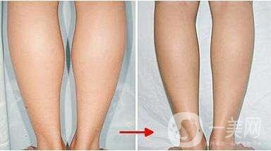 小腿吸脂后多久才能變細(xì)?