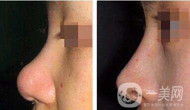 朝天鼻整形可以不放假體嗎?