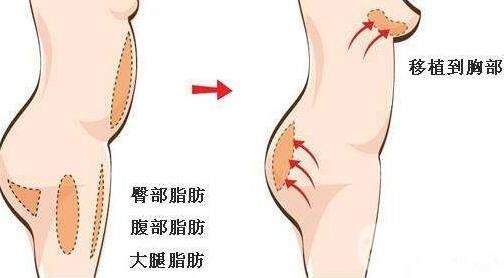 自體脂肪隆胸有什么后遺癥?