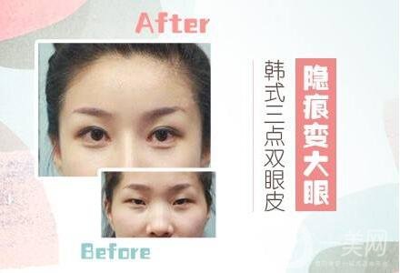 三點雙眼皮能維持幾年?