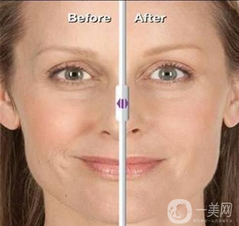 須知_嗨體祛除頸紋的常見的4個問題