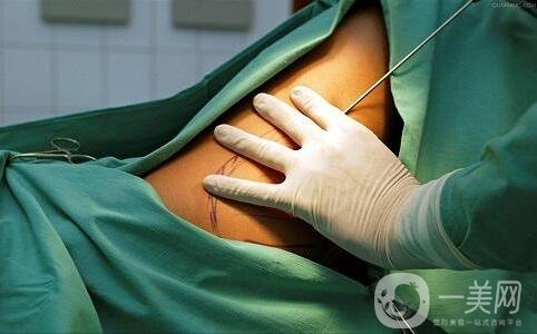 關于吸脂手術的流程與*性，你都知道嗎？