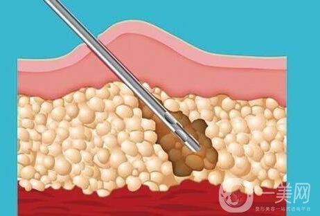 關于吸脂手術的流程與*性，你都知道嗎？