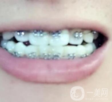 濰坊市人民醫(yī)院 整牙齒