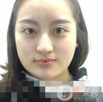 河北省人民醫(yī)院整形外科價格表新版來襲，附去下頜骨案例