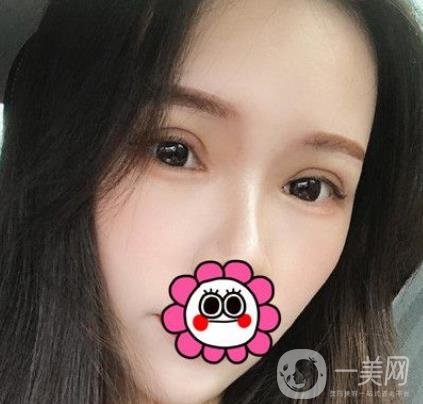 金華中心醫(yī)院整形美容科價格表+割雙眼皮案例一覽