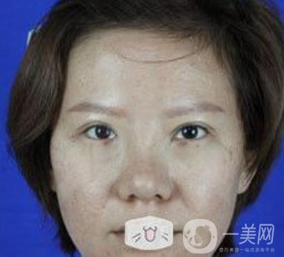 綿陽(yáng)中心醫(yī)院整形美容科價(jià)格表2020發(fā)布，附祛眼袋案例